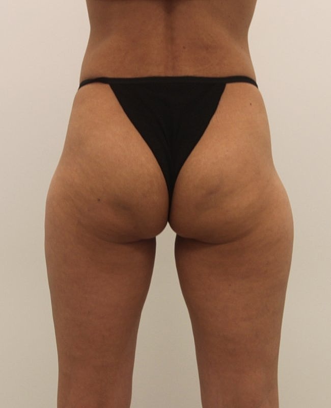 Aveli Cellulite Treatment Before & After