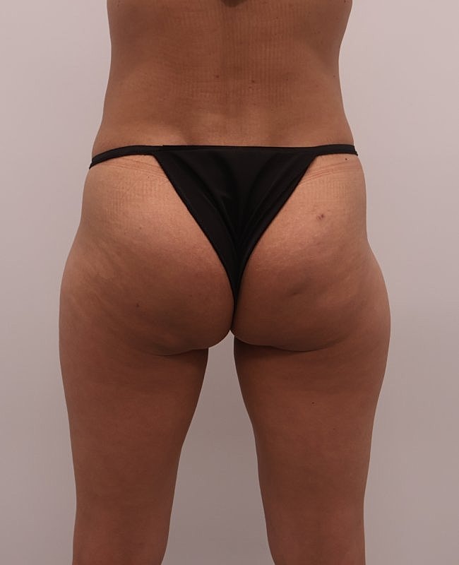 Aveli Cellulite Treatment Before & After