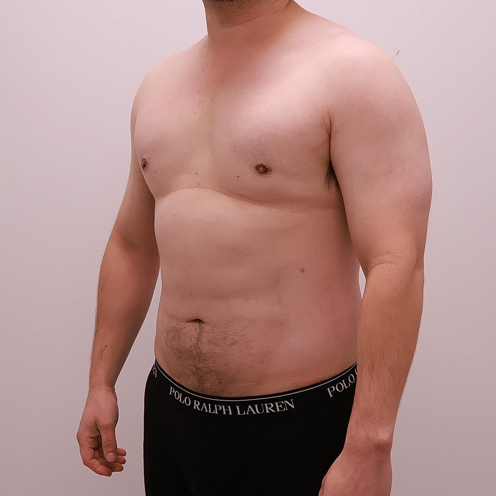 Male Breast Gynecomastia Before & After