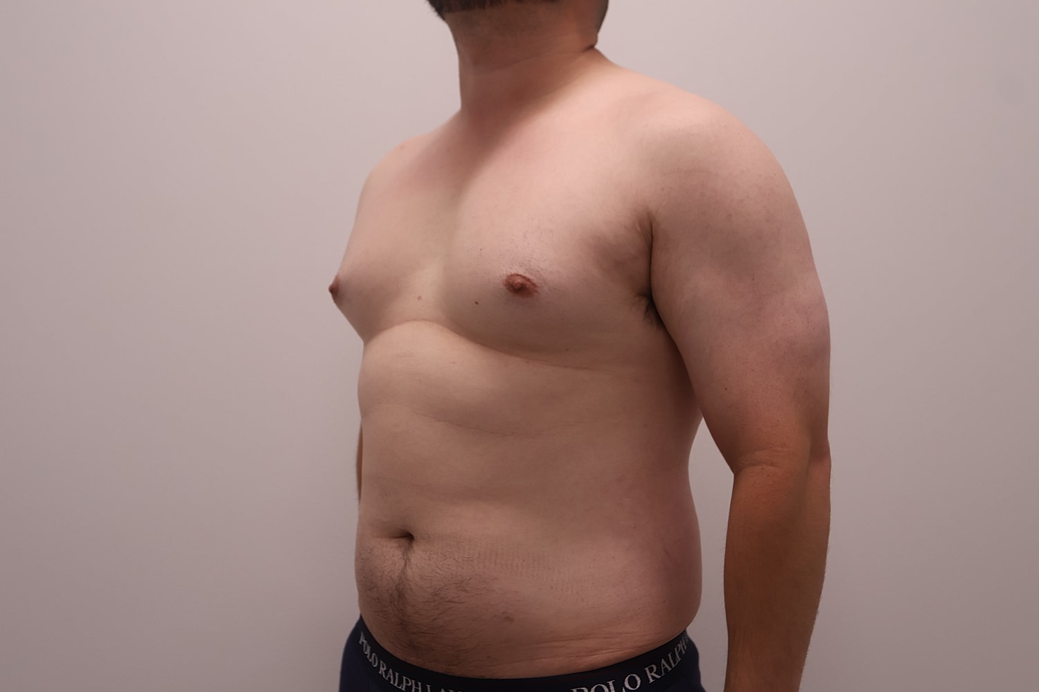 Male Breast Gynecomastia Before & After