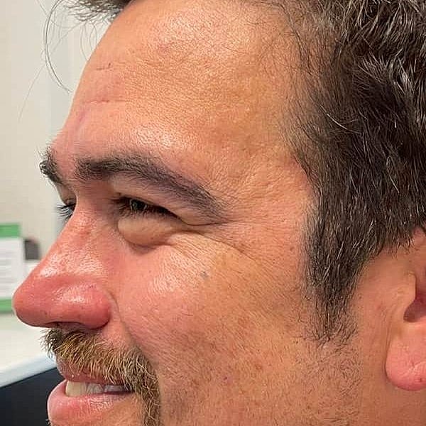 Botox Before & After