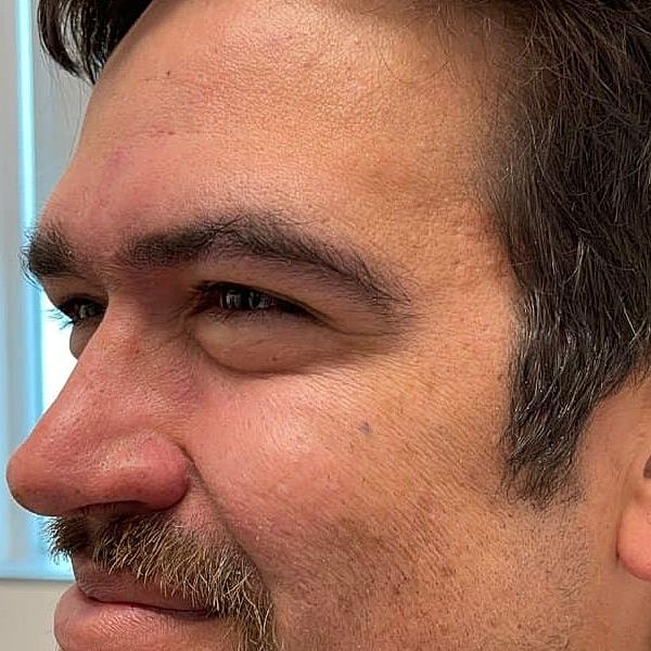 Botox Before & After