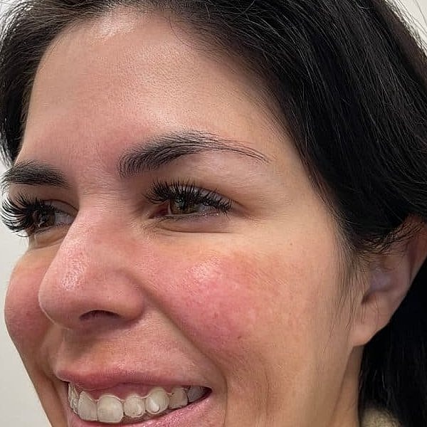 Botox Before & After