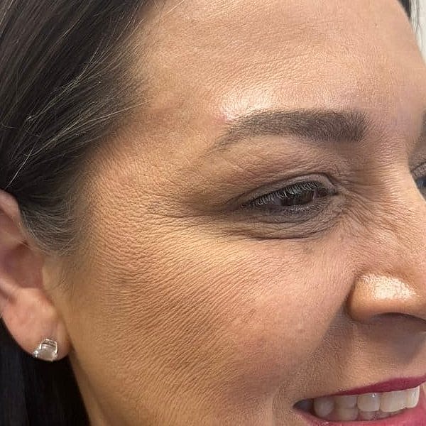 Botox Before & After