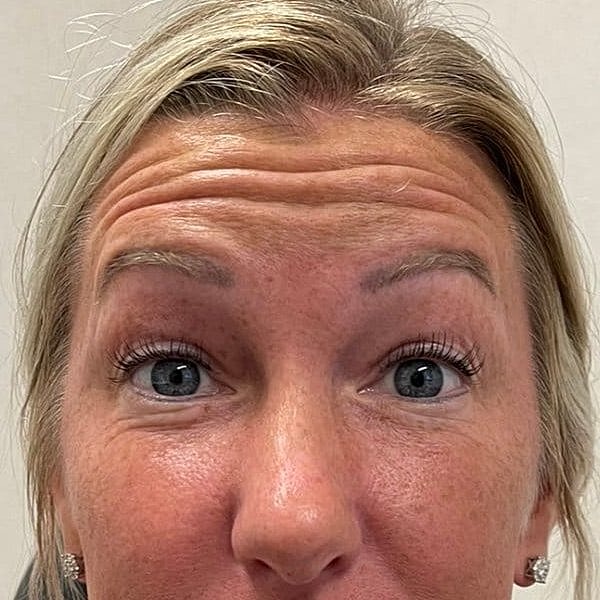 Botox Before & After