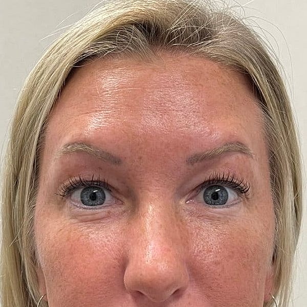 Botox Before & After