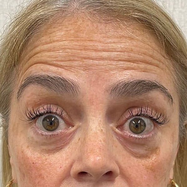 Botox Before & After