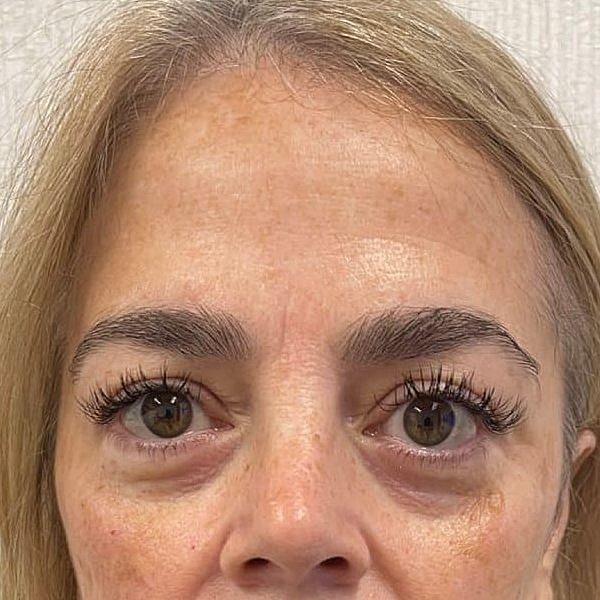 Botox Before & After