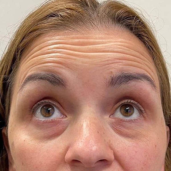 Botox Before & After