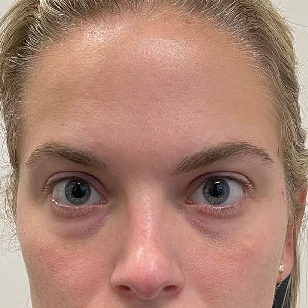 Botox Before & After