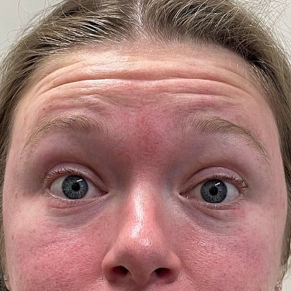 Botox Before & After