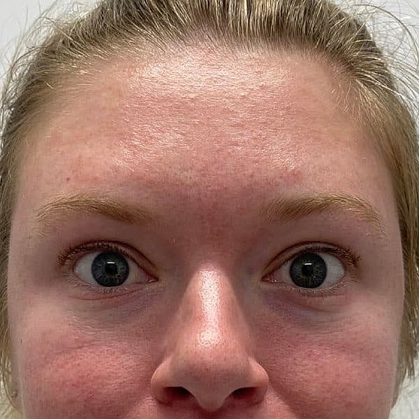 Botox Before & After