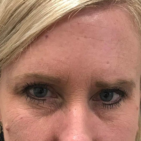 Botox Before & After