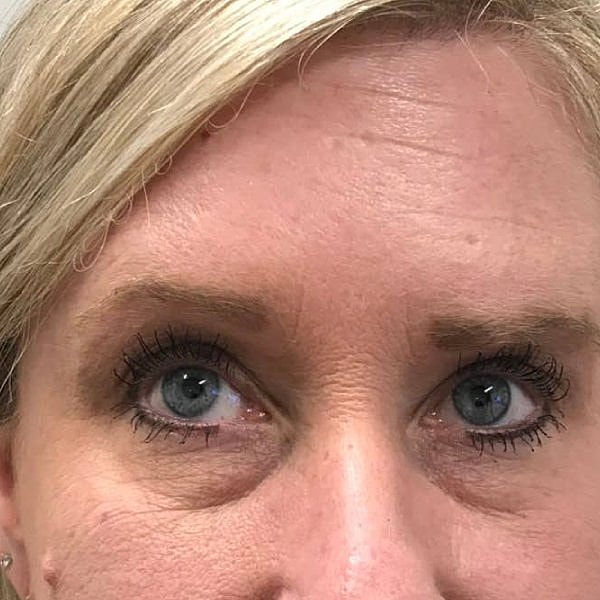 Botox Before & After