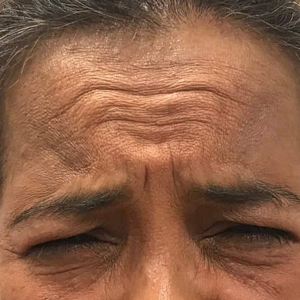 Botox Before & After