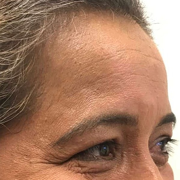 Botox Before & After