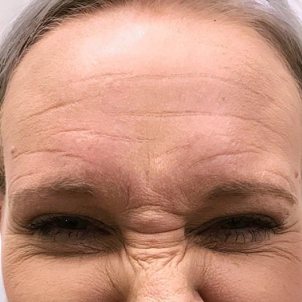 Botox Before & After