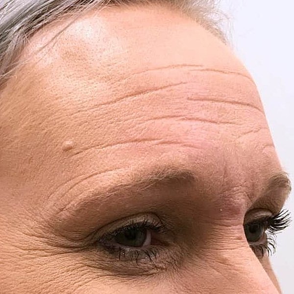 Botox Before & After