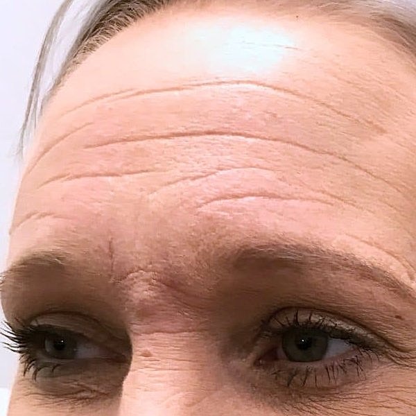 Botox Before & After