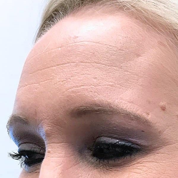 Botox Before & After