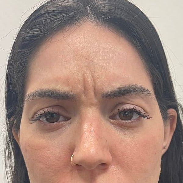 Botox Before & After