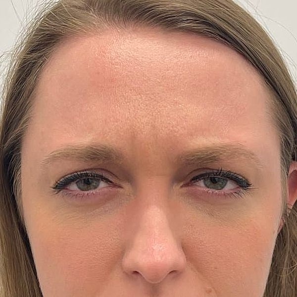 Botox Before & After