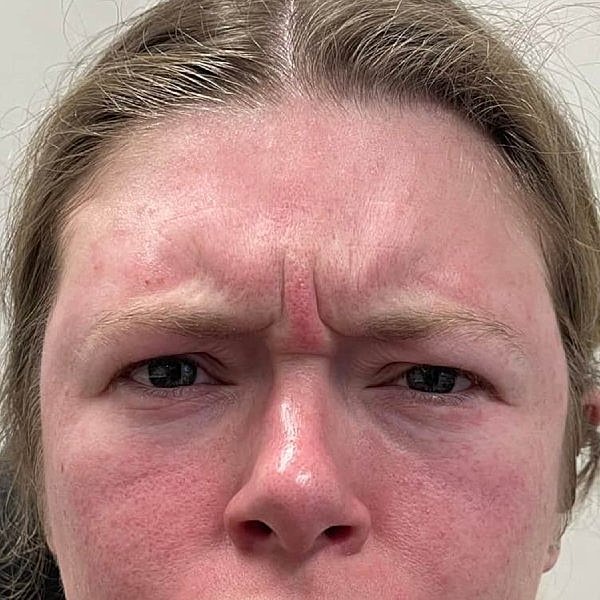 Botox Before & After