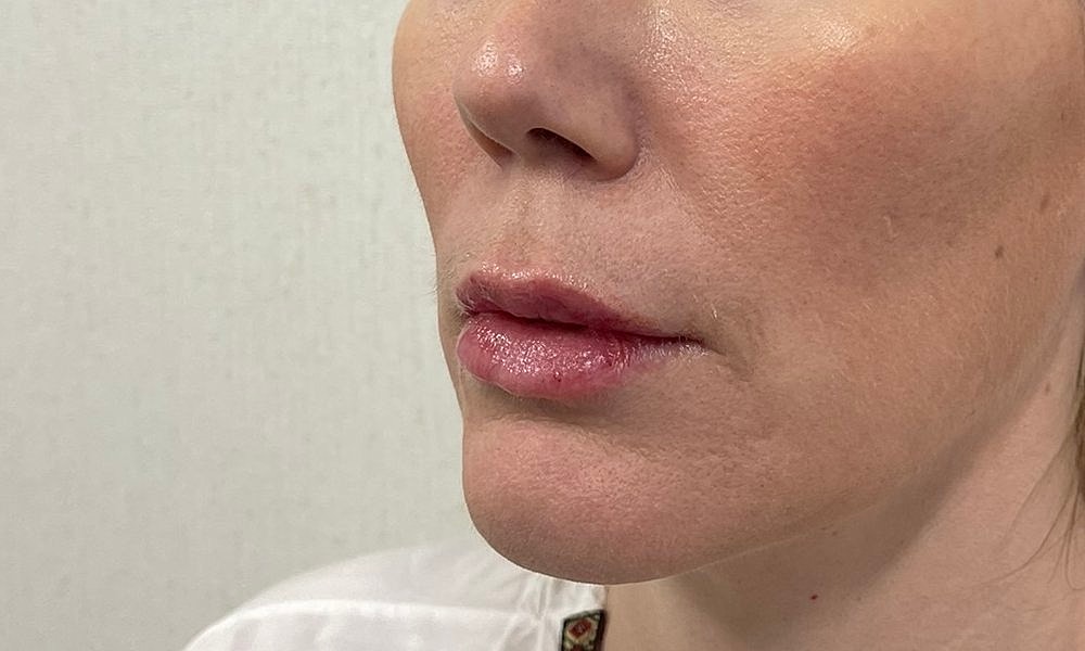 Lip Fillers Before & After