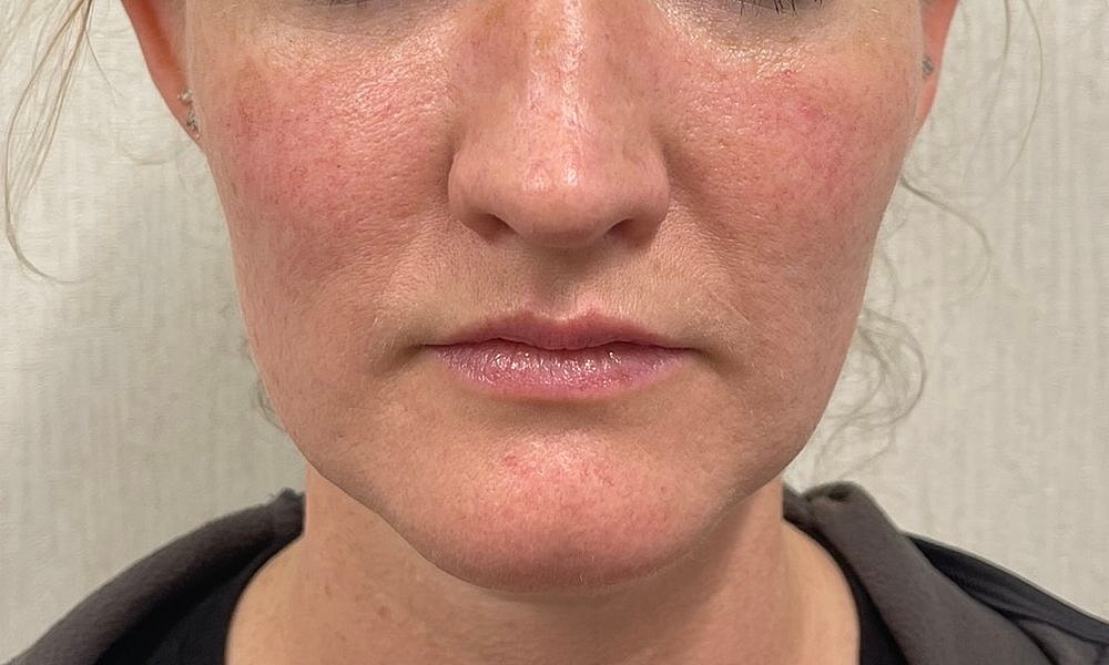 Lip Fillers Before & After