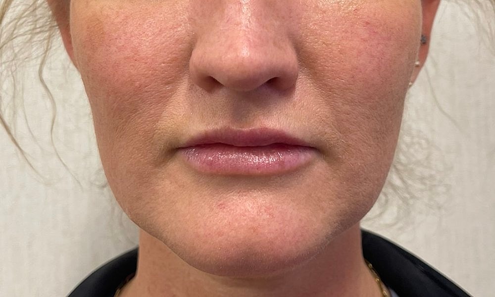 Lip Fillers Before & After