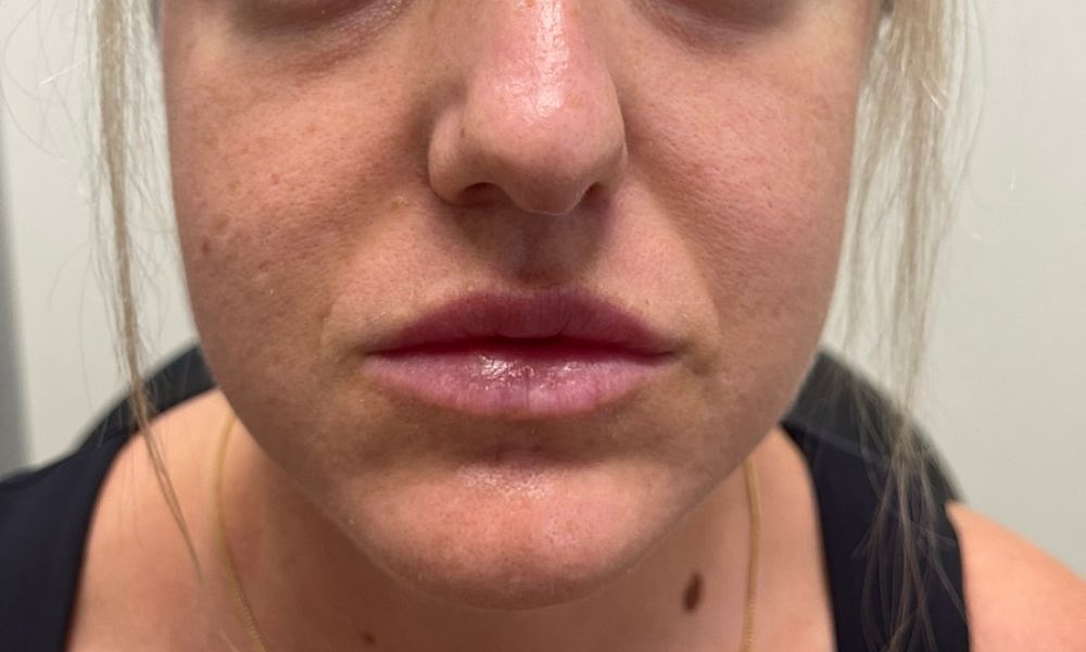 Lip Fillers Before & After