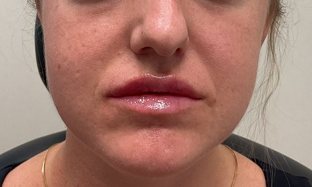 Lip Fillers Before & After