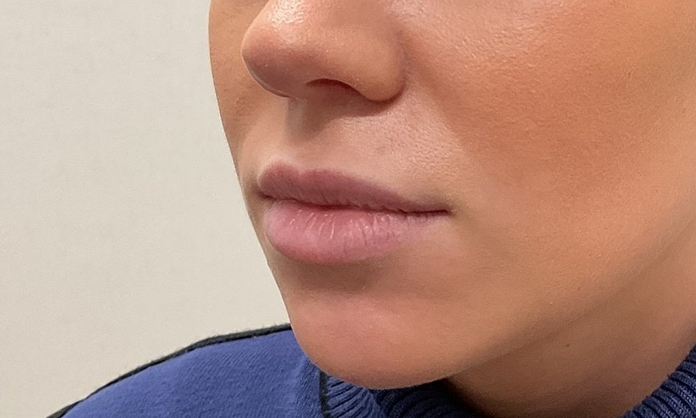 Lip Fillers Before & After