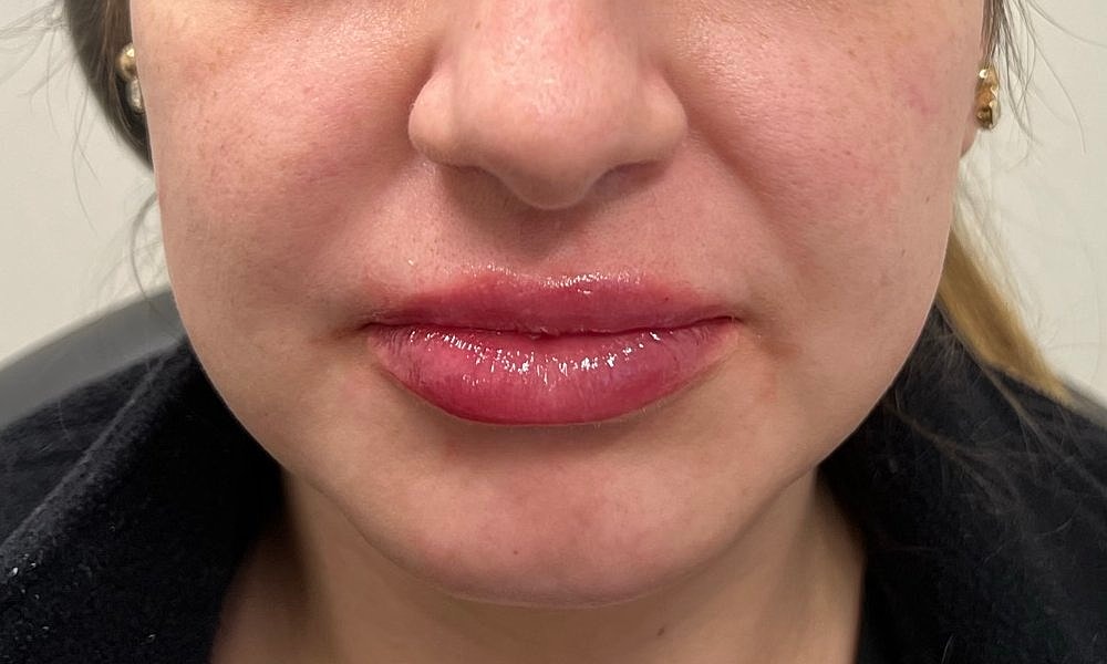 Lip Fillers Before & After