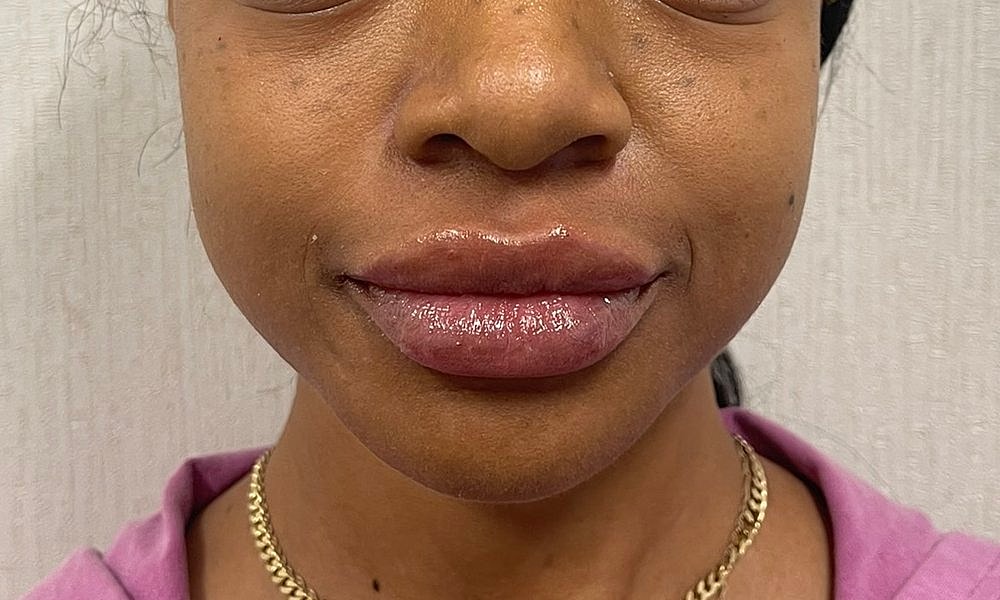 Lip Fillers Before & After