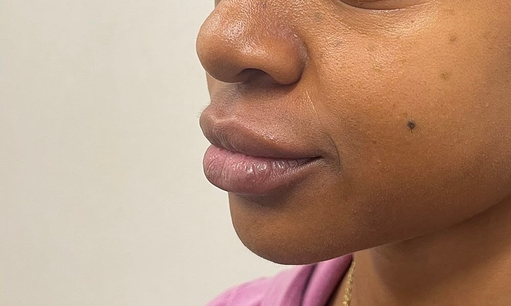 Lip Fillers Before & After