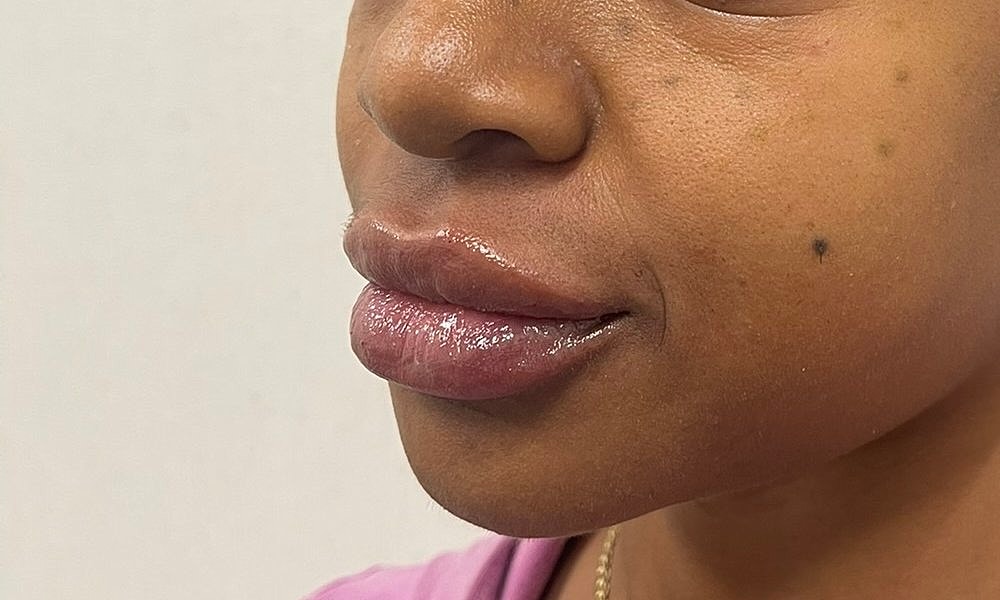 Lip Fillers Before & After