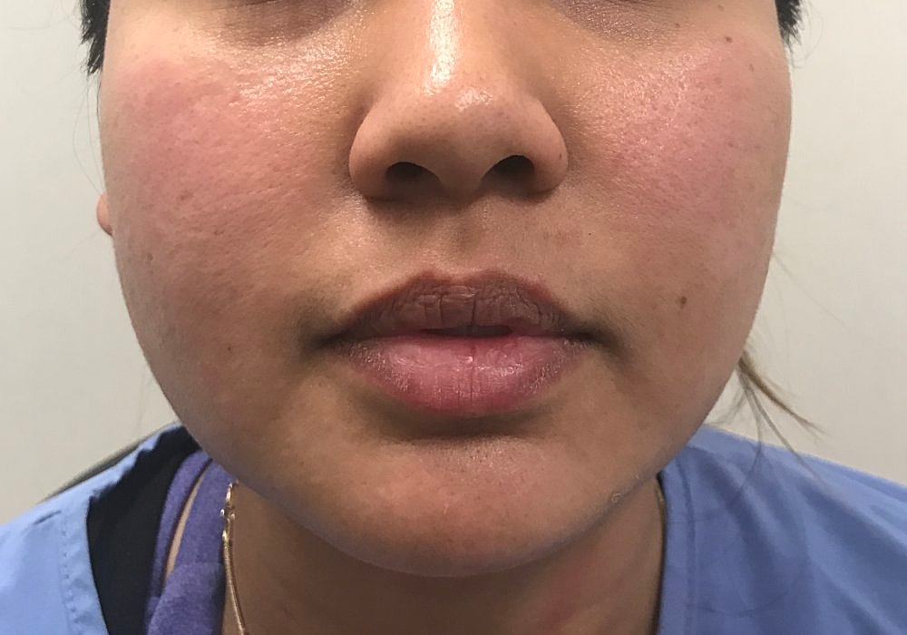 Lip Fillers Before & After