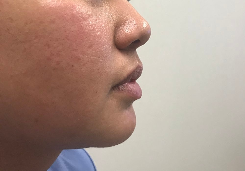 Lip Fillers Before & After