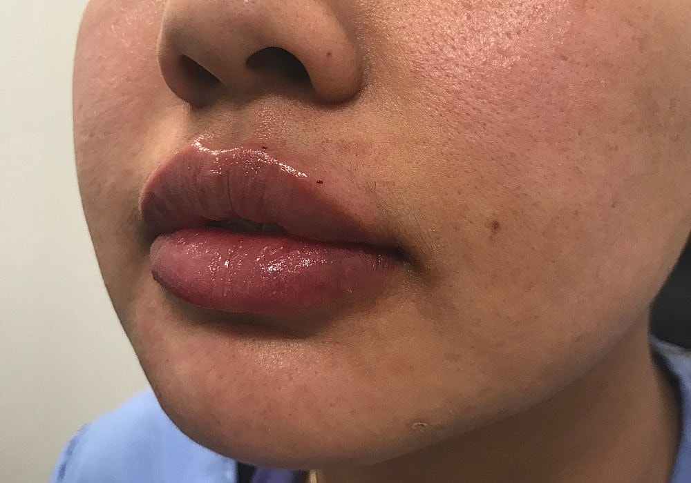 Lip Fillers Before & After