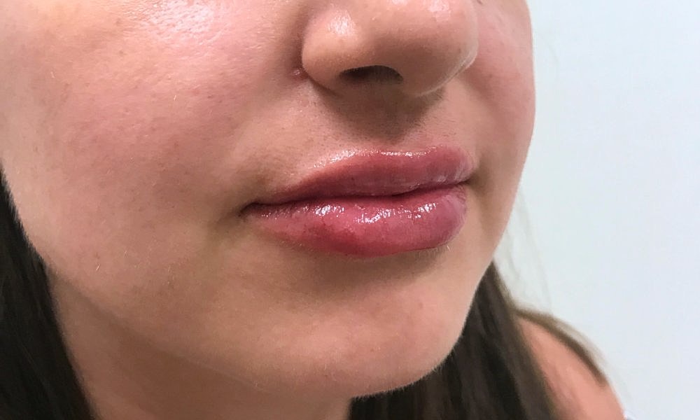 Lip Fillers Before & After