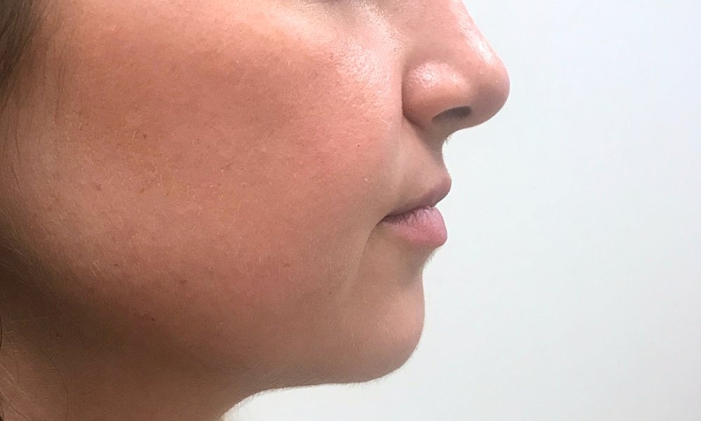 Lip Fillers Before & After