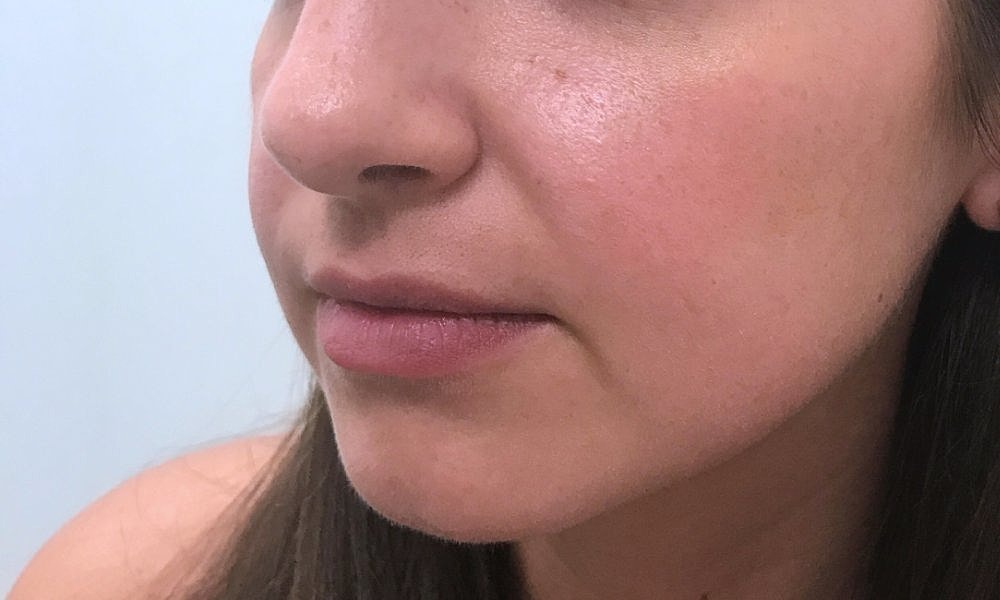 Lip Fillers Before & After