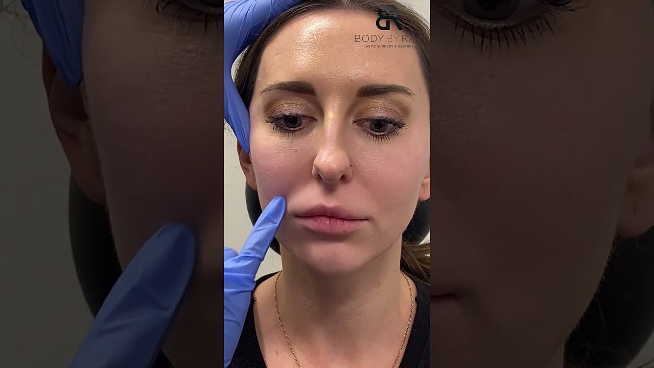 Houston Lip Fillers model receiving treatment
