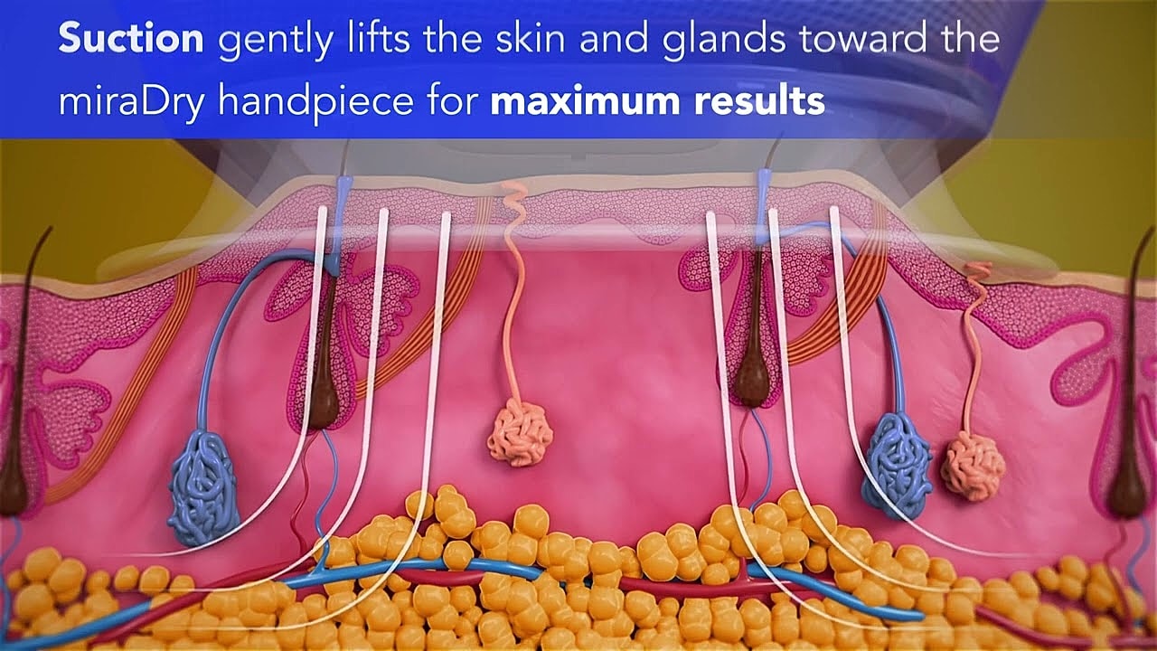 Doctor Ravi in scrubs discussing miraDry procedure