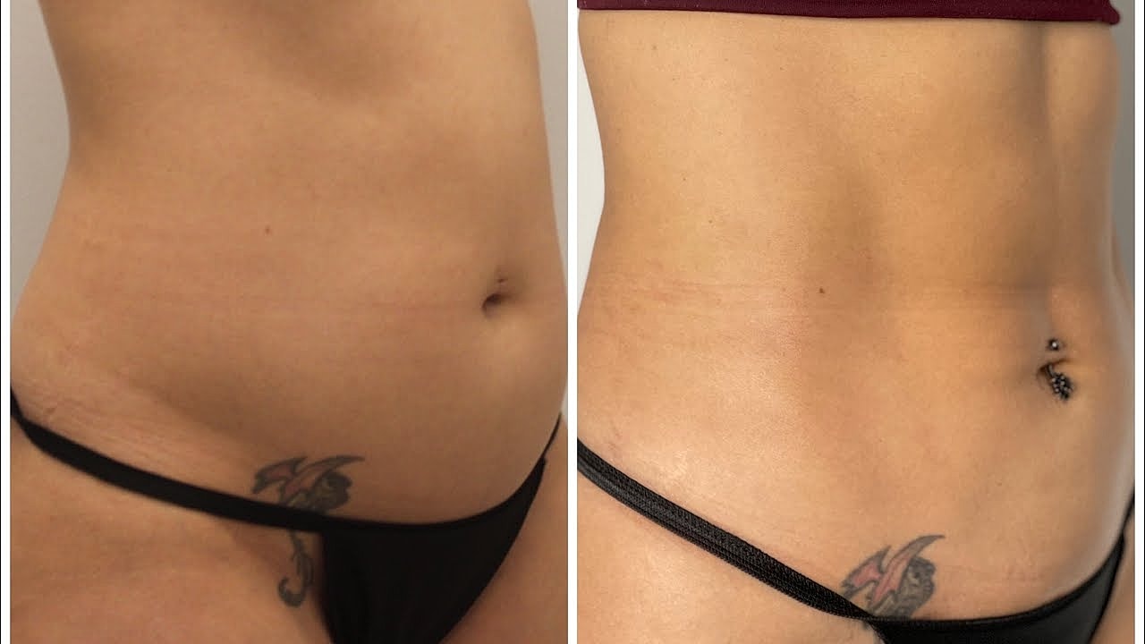Houston vaser liposuction beforfe and after